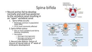 Spina bifida
• Neural arches fail to develop
normally and and fuse posterior
to the vertebral canal resulting in
an "open" vertebral canal
1. Spina bifida occulta
• Relatively common in population
(upto 24%)
• L5-S1 most commonly affected
2. Spina bifida cystica
• One or more vertebral arch fail to
develop completely
• Herniation
• Meninges (meningocoele)
• Meninges and Spinal cord
(meningomyelocoele)
3. Neural tube defects- failure of
closure of neural tube at 4th week of
embryonic development
 