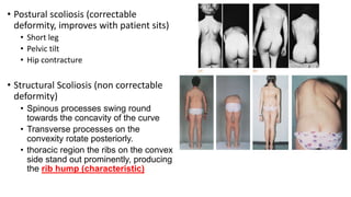 • Postural scoliosis (correctable
deformity, improves with patient sits)
• Short leg
• Pelvic tilt
• Hip contracture
• Structural Scoliosis (non correctable
deformity)
• Spinous processes swing round
towards the concavity of the curve
• Transverse processes on the
convexity rotate posteriorly.
• thoracic region the ribs on the convex
side stand out prominently, producing
the rib hump (characteristic)
 