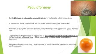 Peau d’orange
Due to blockage of subareolar lymphatic plexus by metastatic cells (lymphedema)
In turn causes deviation of nipple and thickened leather-like appearance of skin
Prominent or puffy skin between dimpled pores  orange –peel appearance (peau d’orange
sign)
Larger dimples (fingertip size or bigger) due to cancerous invasion of glandular tissue and
fibrosis (fibrous degeneration), causing shortening, places traction on suspensory
ligaments.
Subareaolar breast cancer may cause inversion of nipple by similar mechanism involving
lactiferous ducts
 