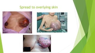 Spread to overlying skin
 