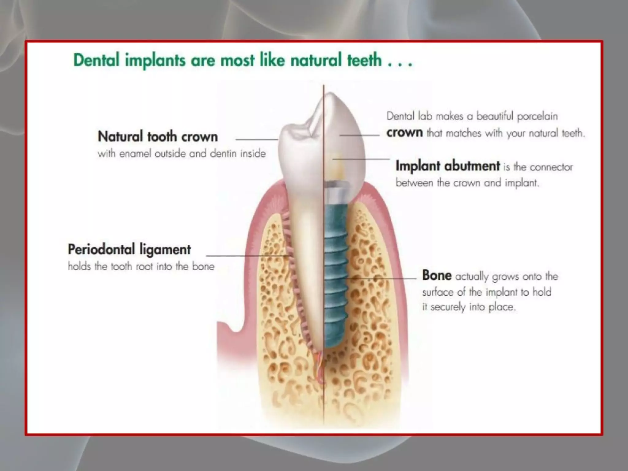 Anatomical consideration for dental implant | PDF