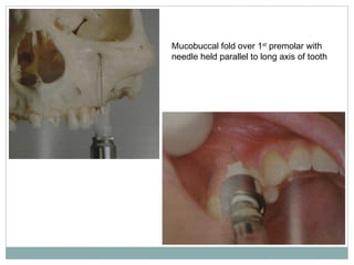 Mucobuccal fold over 1st
premolar with
needle held parallel to long axis of tooth
 