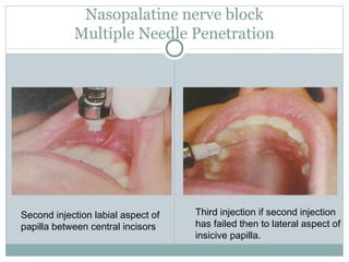 Nasopalatine nerve block
Multiple Needle Penetration
Second injection labial aspect of
papilla between central incisors
Th...
