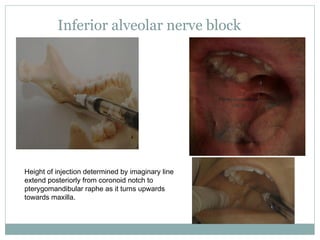 Inferior alveolar nerve block
Height of injection determined by imaginary line
extend posteriorly from coronoid notch to
p...