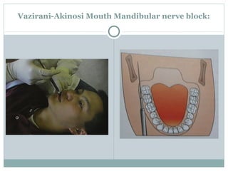 Vazirani-Akinosi Mouth Mandibular nerve block:
 