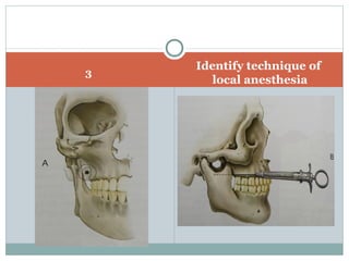 3
Identify technique of
local anesthesia
 