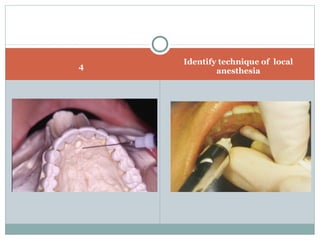 4
Identify technique of local
anesthesia
 