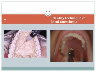 7
Identify technique of
local anesthesia
 
