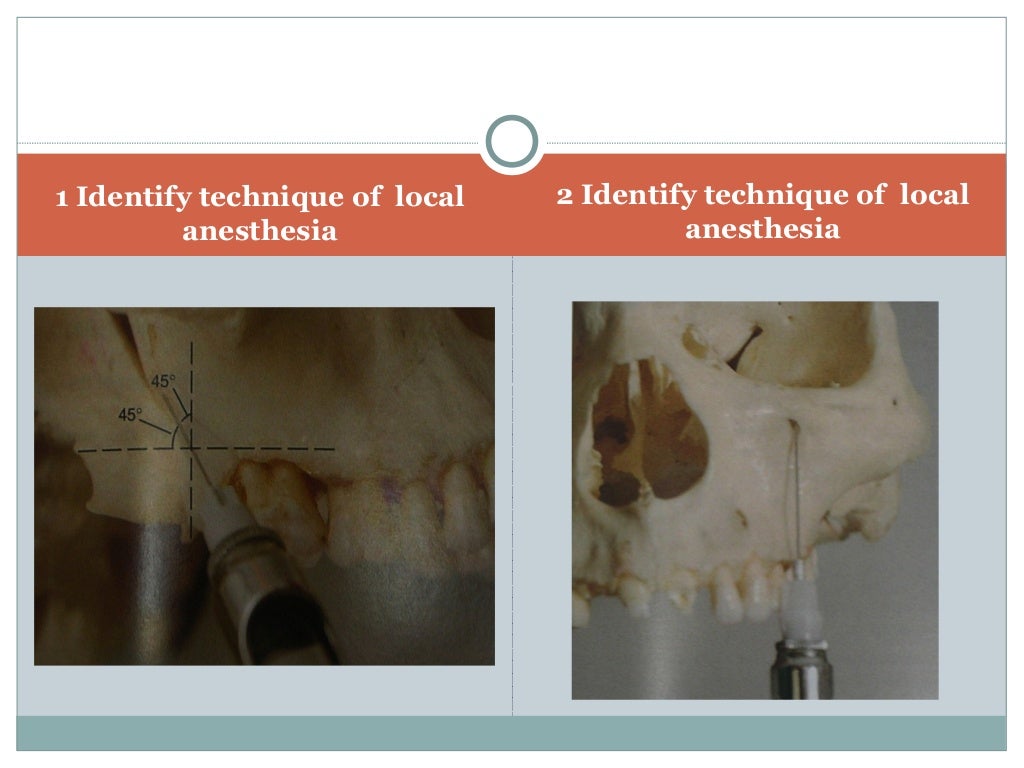 Anatomical correlation of local anesthesia in dentistry