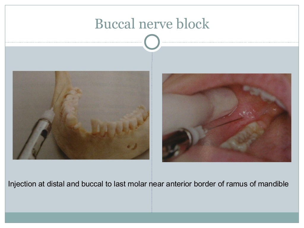 Anatomical correlation of local anesthesia in dentistry
