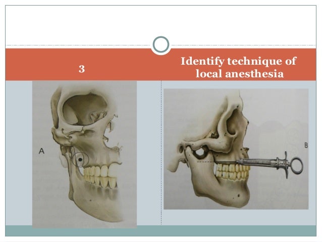 dental anesthesia