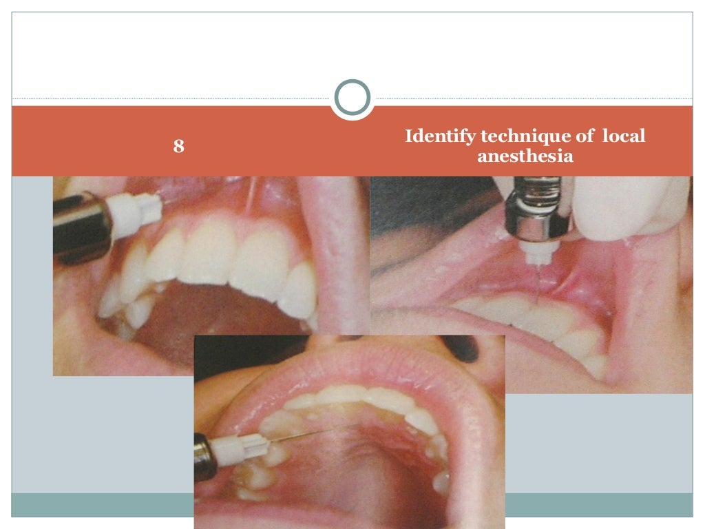 Anatomical correlation of local anesthesia in dentistry