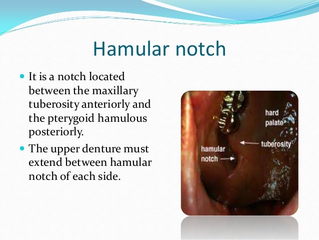 hamular notch