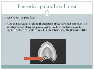 Posterior palatal seal area
Also known as post dam.
“The soft tissues at or along the junction of the hard and soft palate on
which pressure along the physiological limits of the tissues can be
applied by the the denture to aid in the retention of the denture.”-GPT
 