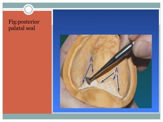 Fig:posterior
palatal seal
 