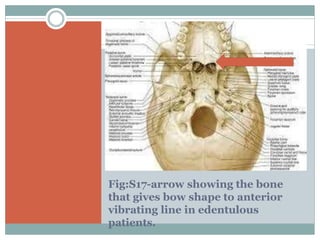 Fig:S17-arrow showing the bone
that gives bow shape to anterior
vibrating line in edentulous
patients.
 