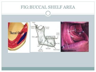 FIG:BUCCAL SHELF AREA
 