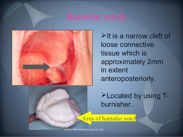 anatomical landmarks 2 prosthodontic courses hamular notch