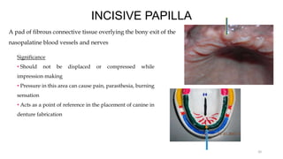 INCISIVE PAPILLA
A pad of fibrous connective tissue overlying the bony exit of the
nasopalatine blood vessels and nerves
20
Significance
• Should not be displaced or compressed while
impression making
• Pressure in this area can cause pain, parasthesia, burning
sensation
• Acts as a point of reference in the placement of canine in
denture fabrication
 