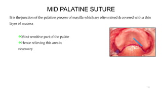 MID PALATINE SUTURE
It is the junction of the palatine process of maxilla which are often raised & covered with a thin
layer of mucosa
Most sensitive part of the palate
Hence relieving this area is
necessary
21
 