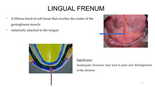 LINGUAL FRENUM
• A fibrous band of soft tissue that overlies the center of the
genioglossus muscle
• Anteriorly attached to the tongue
28
Significance
Inadequate clearance may lead to pain and dislodgement
of the denture
 