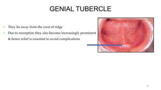 GENIAL TUBERCLE
• They lie away from the crest of ridge
• Due to resorption they also become increasingly prominent
& hence relief is essential to avoid complications
40
 