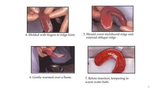 5. Should cover mylohyoid ridge and
external oblique ridge.
4. Molded with fingers to ridge form.
6. Gently warmed over a flame. 7. Before insertion, tempering in
warm water bath.
50
 