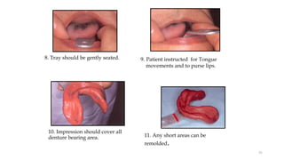 9. Patient instructed for Tongue
movements and to purse lips.
8. Tray should be gently seated.
11. Any short areas can be
remolded.
10. Impression should cover all
denture bearing area.
51
 