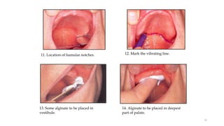 11. Location of hamular notches. 12. Mark the vibrating line.
13. Some alginate to be placed in
vestibule.
14. Alginate to be placed in deepest
part of palate.
55
 