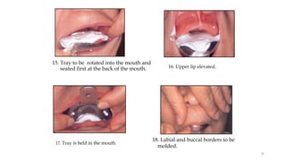 15. Tray to be rotated into the mouth and
seated first at the back of the mouth. 16. Upper lip elevated.
17. Tray is held in the mouth.
18. Labial and buccal borders to be
molded.
56
 
