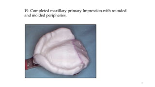 19. Completed maxillary primary Impression with rounded
and molded peripheries.
57
 