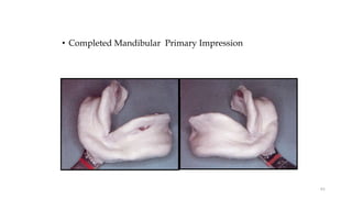 • Completed Mandibular Primary Impression
61
 