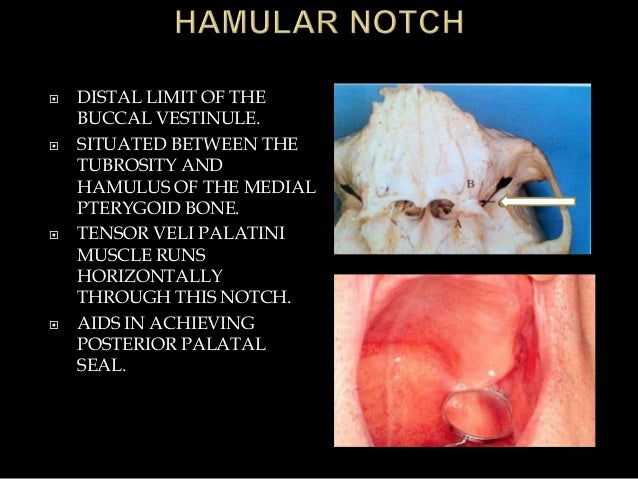 anatomical landmarks of denture bearing area of pptx final hamular notch