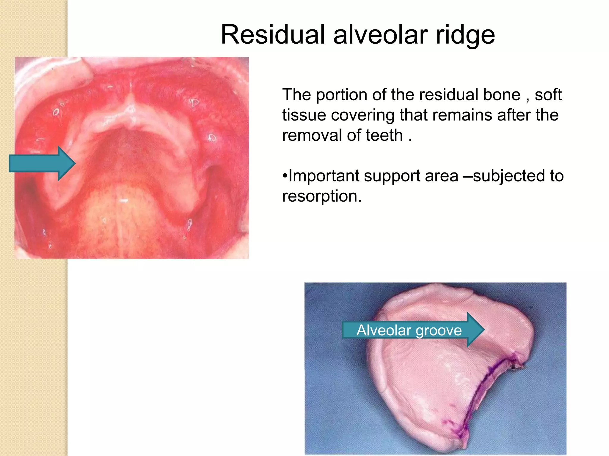 Lower Alvedar Ridge ANATOMICAL LANDMARKS OF EDENTULOUS MOUTH IN COMPLETE DENTURE.pptx