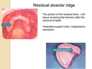 ANATOMICAL LANDMARKS OF EDENTULOUS MOUTH IN COMPLETE DENTURE.pptx