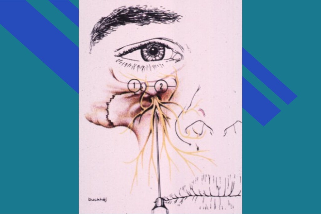 Anatomical landmarks of local anesthesia / oral surgery courses