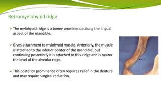 Retromyelohyoid ridge
 The mylohyoid ridge is a boney prominence along the lingual
aspect of the mandible.
 Gives attachment to mylohyoid muscle. Anteriorly, the muscle
is attached to the inferior border of the mandible, but
continuing posteriorly it is attached to this ridge and is nearer
the level of the alveolar ridge.
 This posterior prominence often requires relief in the denture
and may require surgical reduction.
 