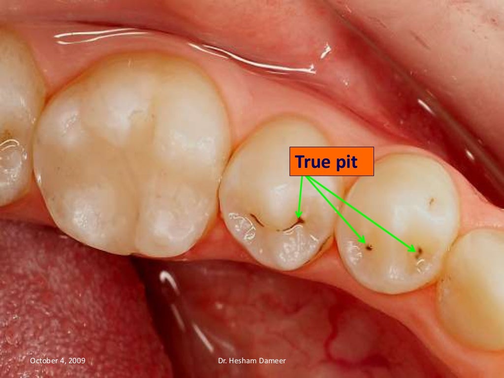 Anatomical landmarks of the crown