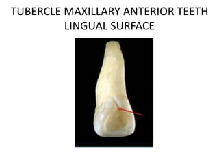 TUBERCLE MAXILLARY ANTERIOR TEETH
LINGUAL SURFACE
 