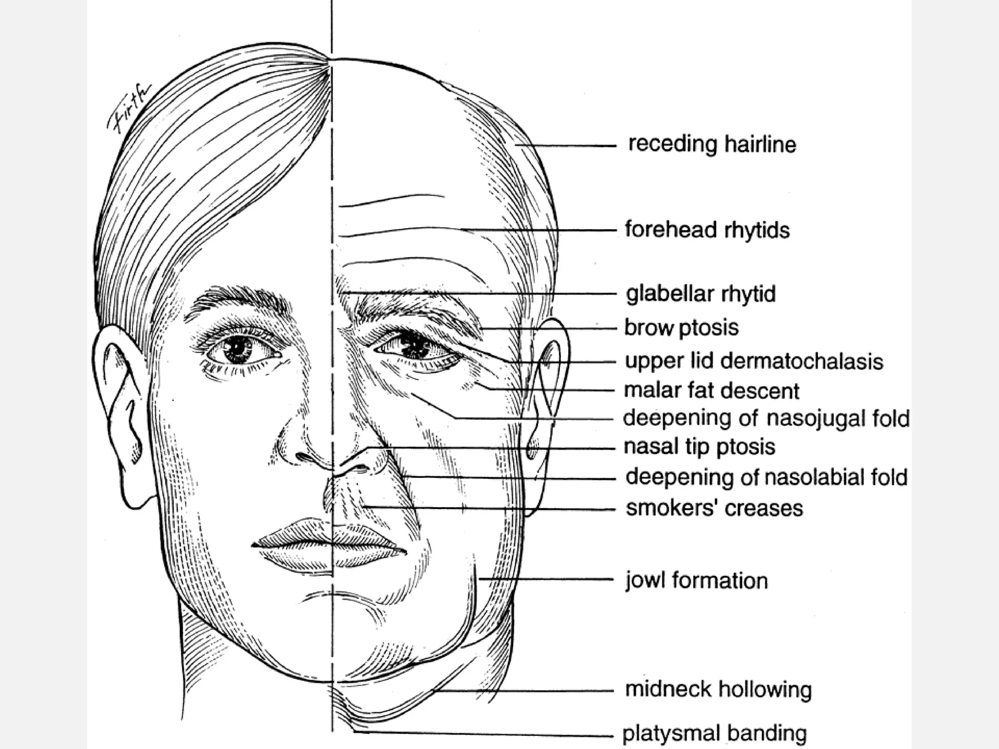 Anatomic and physiological ocular changes with age final | PPT