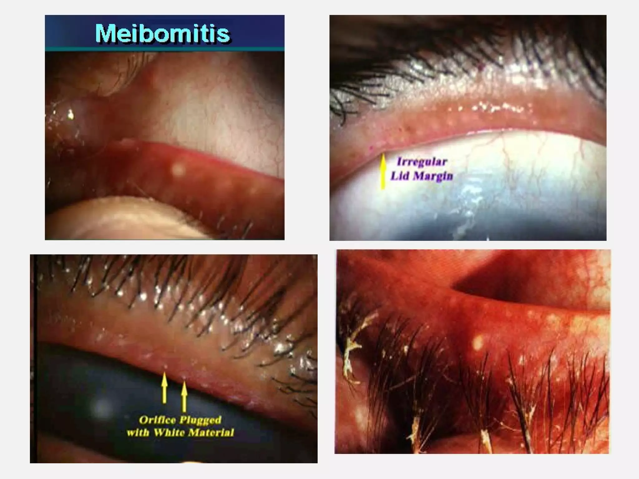 Anatomic and physiological ocular changes with age final | PPT