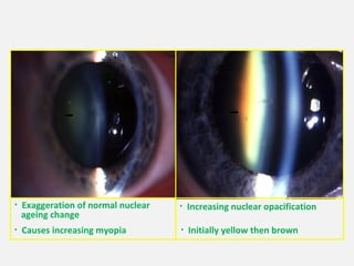 Anatomic and physiological ocular changes with age final | PPT