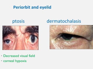 • Decreased visual field
• corneal hypoxia
dermatochalasisptosis
Periorbit and eyelid
 