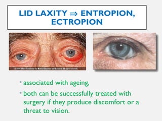LID LAXITY ⇒ ENTROPION,
ECTROPION
• associated with ageing,
• both can be successfully treated with
surgery if they produce discomfort or a
threat to vision.
 