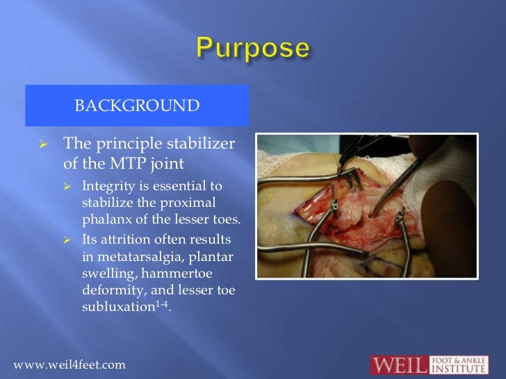 Anatomic Plantar Plate Repair Anatomic Plantar Plate Repair