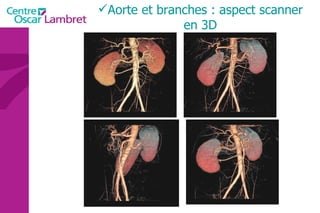 Aorte et branches : aspect scanner en 3D 