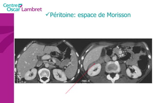 Péritoine: espace de Morisson 