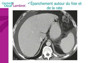 Épanchement autour du foie et de la rate 