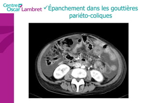 Épanchement dans les gouttières pariéto-coliques 