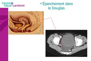 Épanchement dans le Douglas 